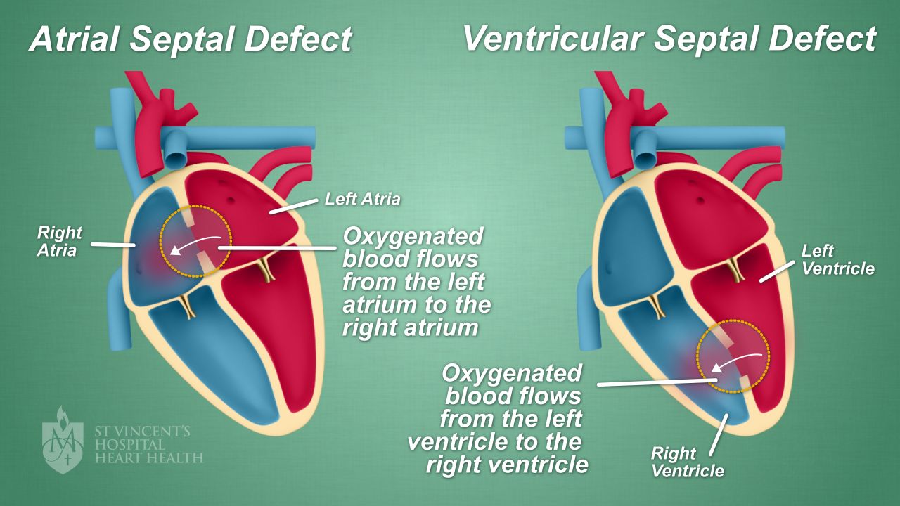 03_ASD-VSD_svhearthealth