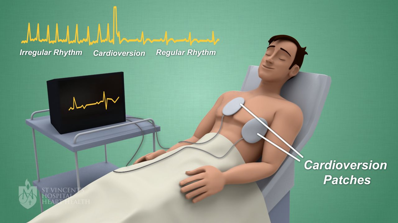 05_Cardioversion_svhearthealth
