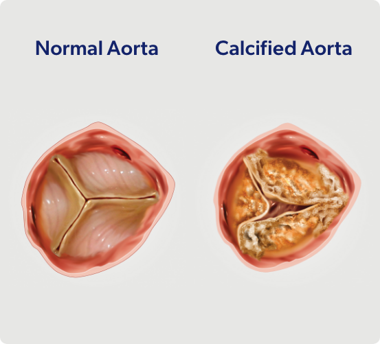 Calcified Aorta